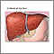 Cirrhosis of the liver