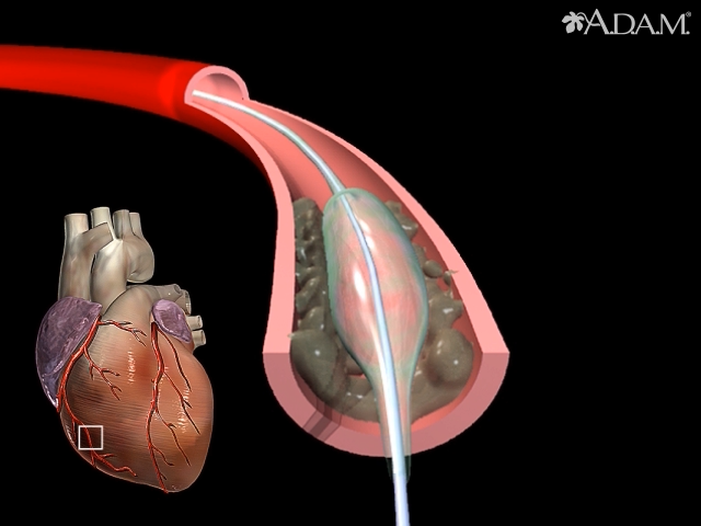 Baars instinct Land Balloon angioplasty - short segment - Health Video: MedlinePlus Medical  Encyclopedia