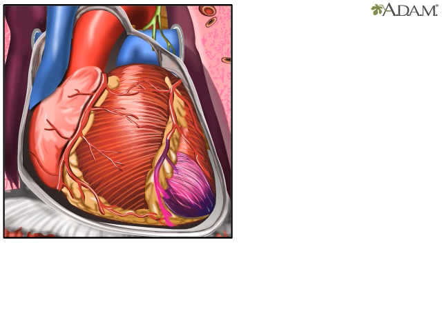 Heart attack: MedlinePlus Medical Encyclopedia