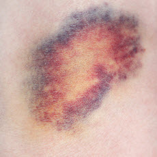 Old age bruises