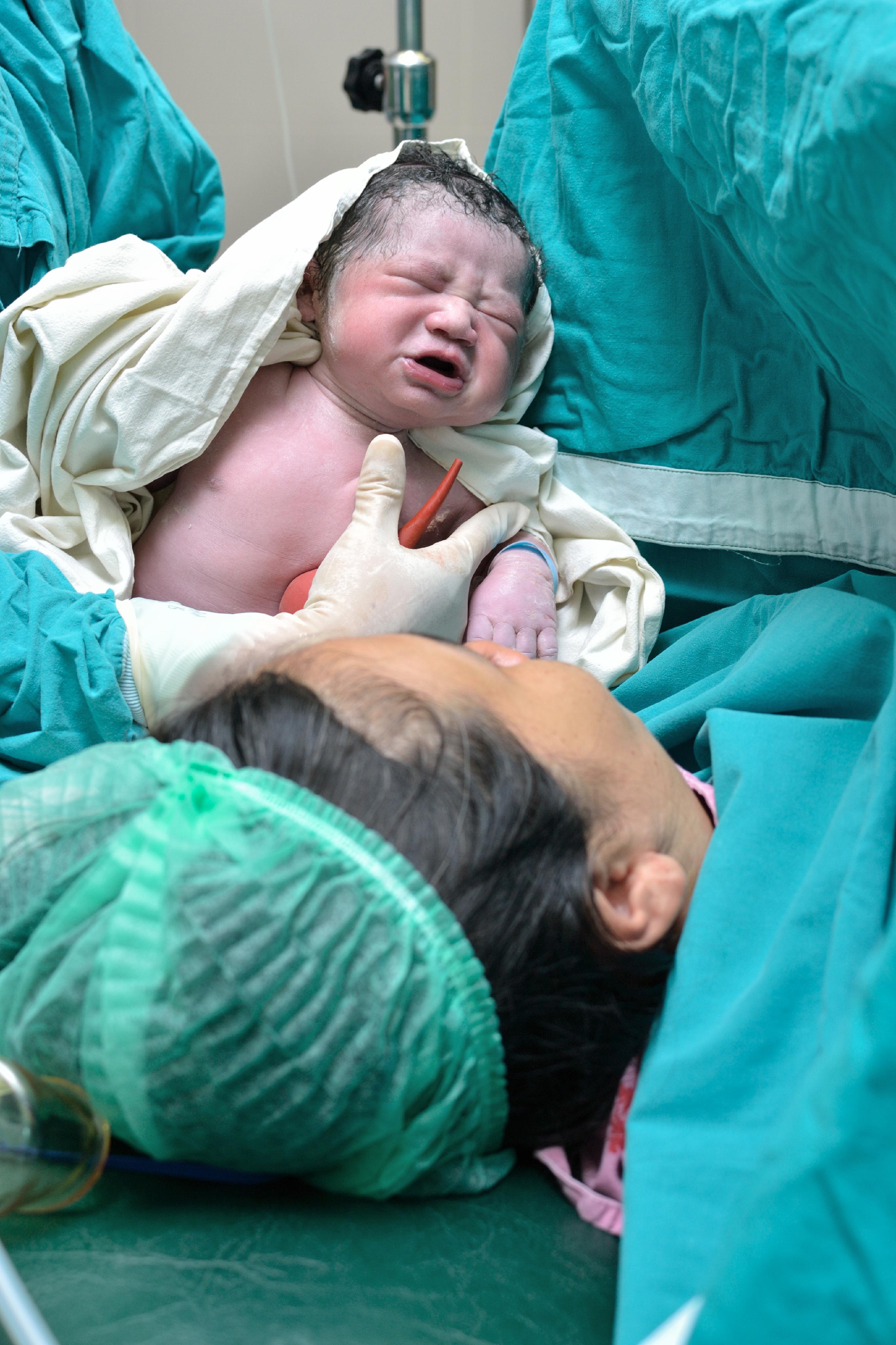 Cesarean Section C Section MedlinePlus