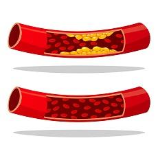 Niveles de colesterol Lo que usted debe saber