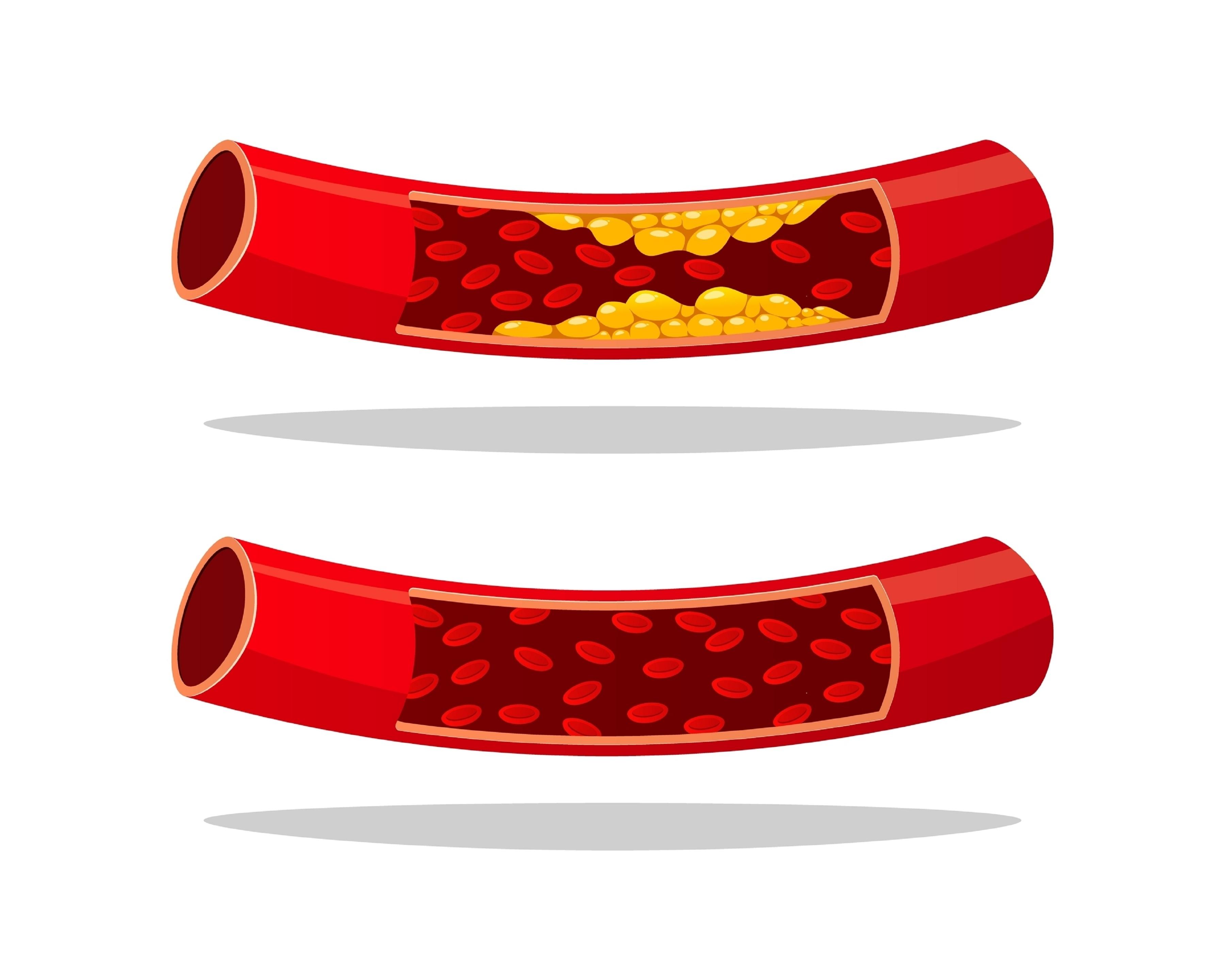 Cholesterol Levels: What You Need to Know: MedlinePlus, image size:3600x2880