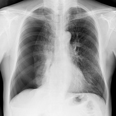 Collapsed Lung | Atelectasis | Pneumothorax | MedlinePlus