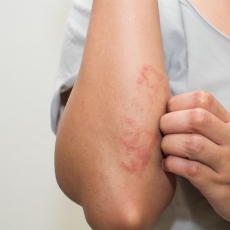 eczema causas piros foltok a kezeken egy pont belsejében