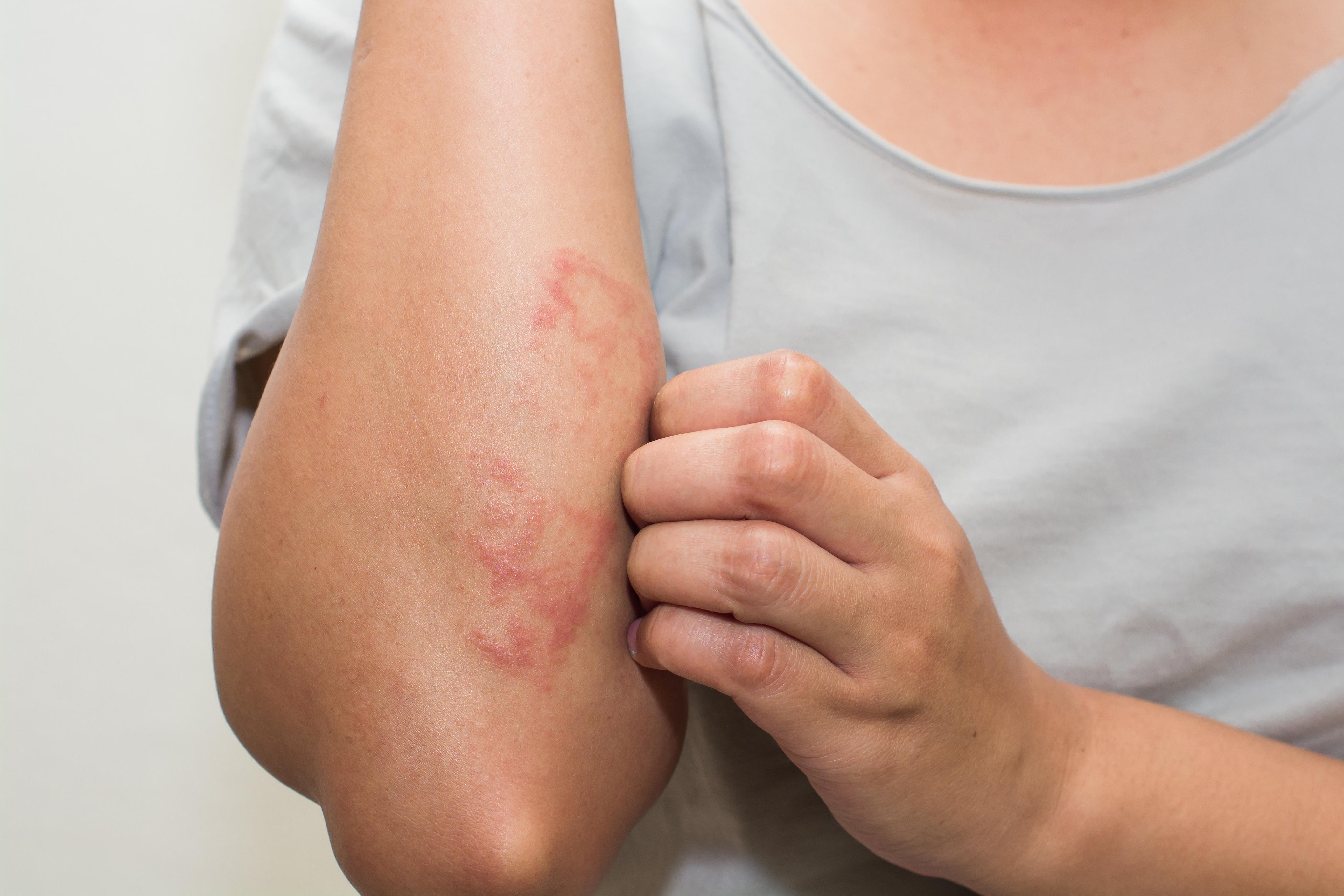 Qué es y cuáles son los síntomas de la dermatitis seborreica? - EL