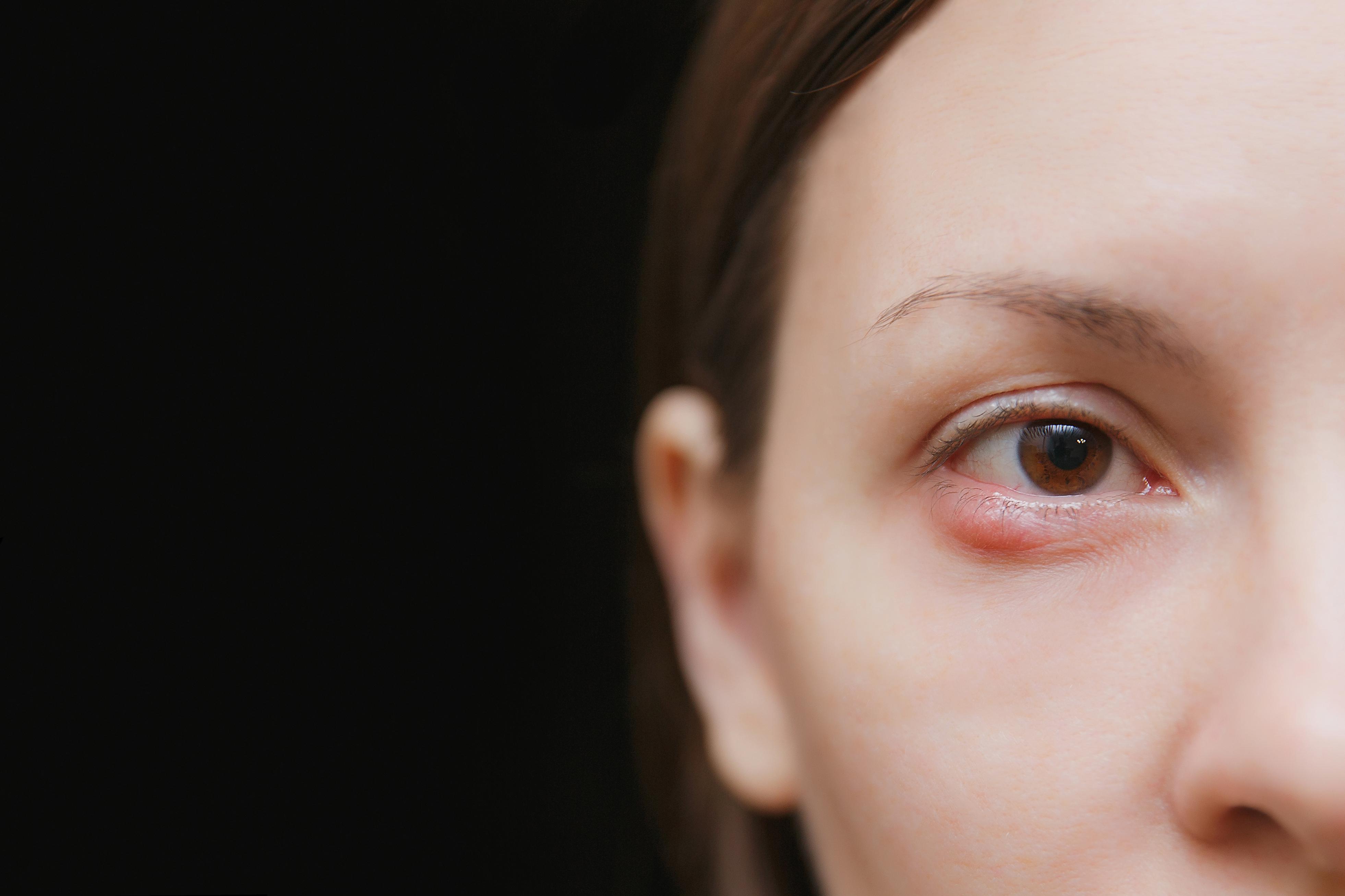 eye bacterial infection