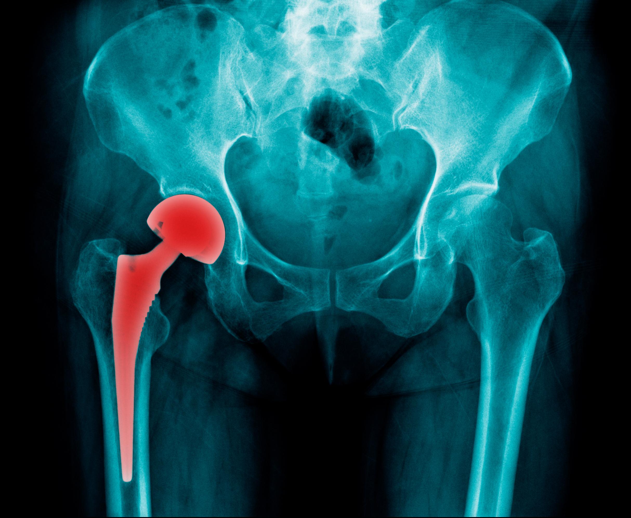Total Hip Replacement 