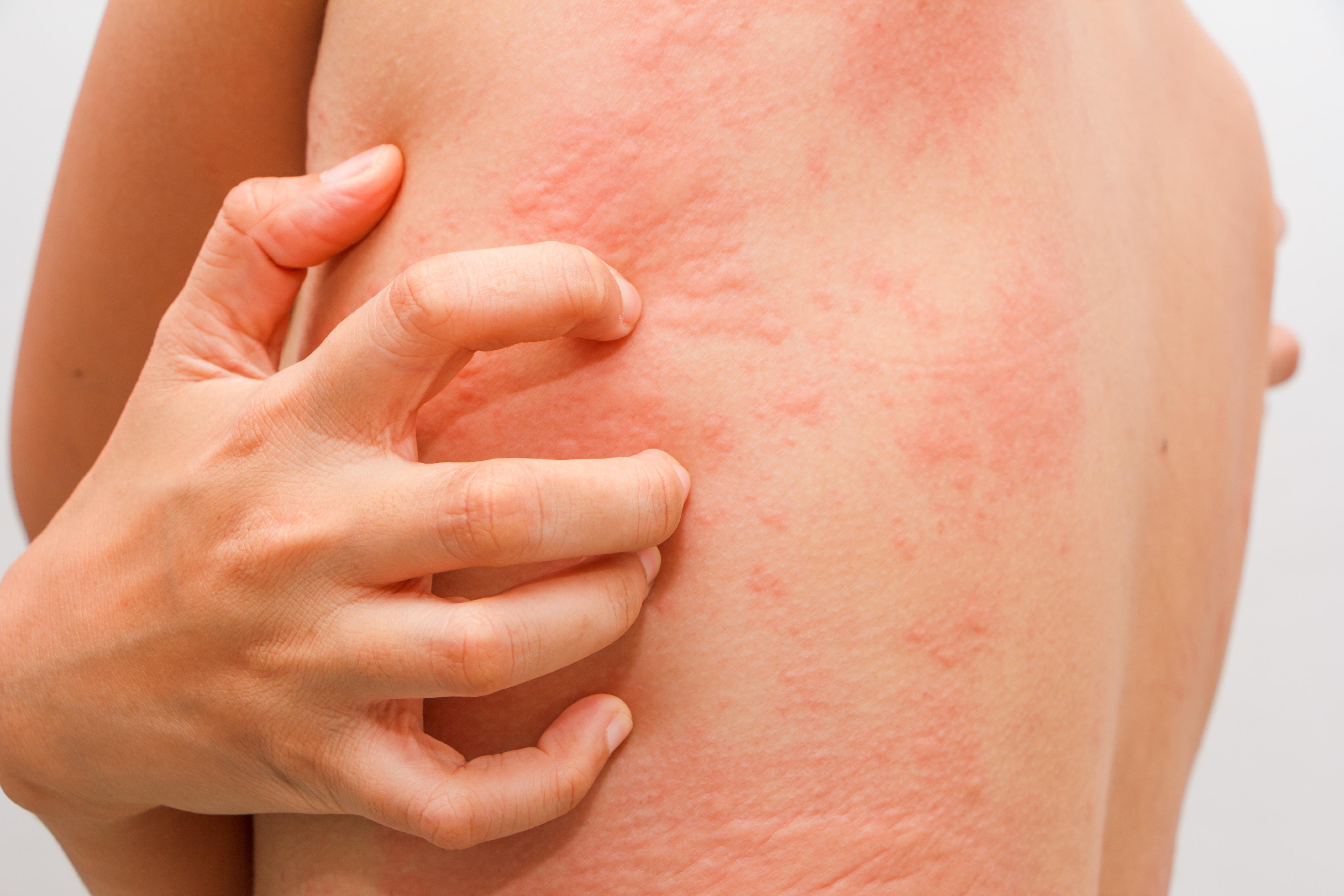Hives | Rash | Skin Rash | Itchy Skin | MedlinePlus