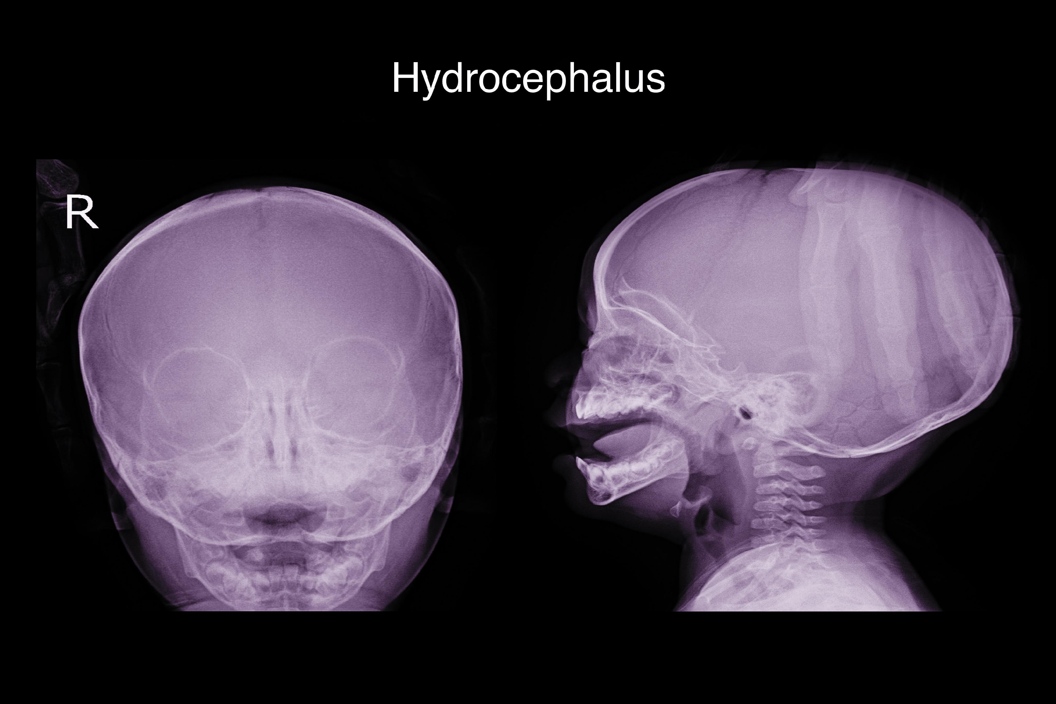 Hydrocephalus | Water on the Brain | MedlinePlus