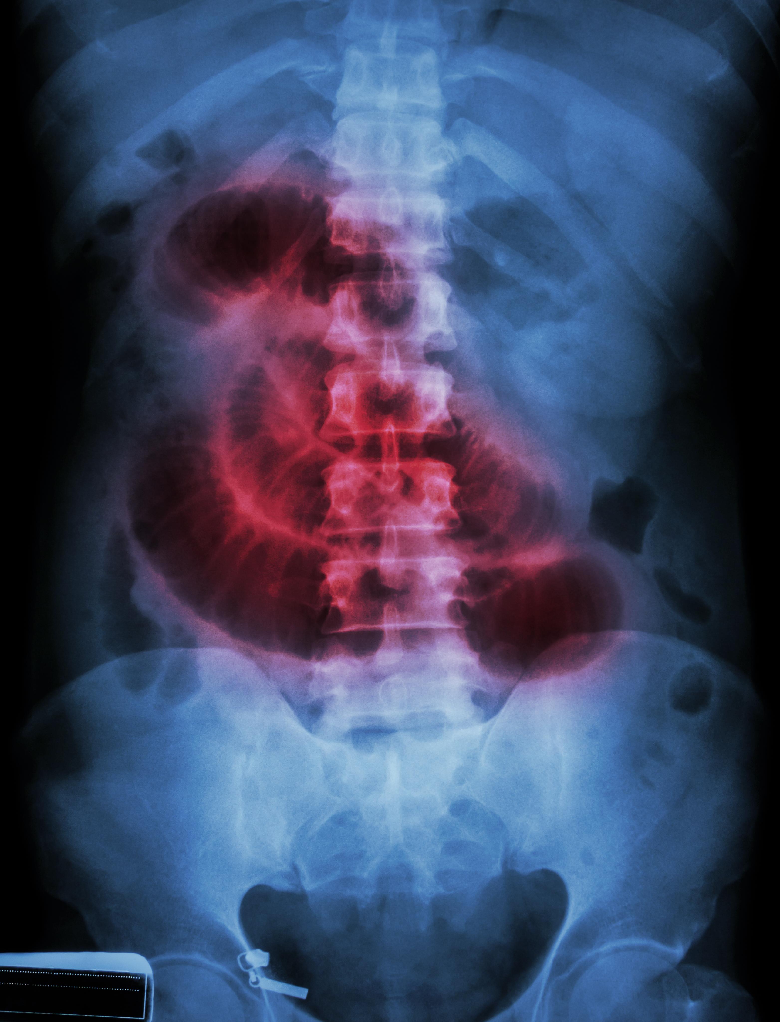 Bowel Obstruction or Intestinal Blockage