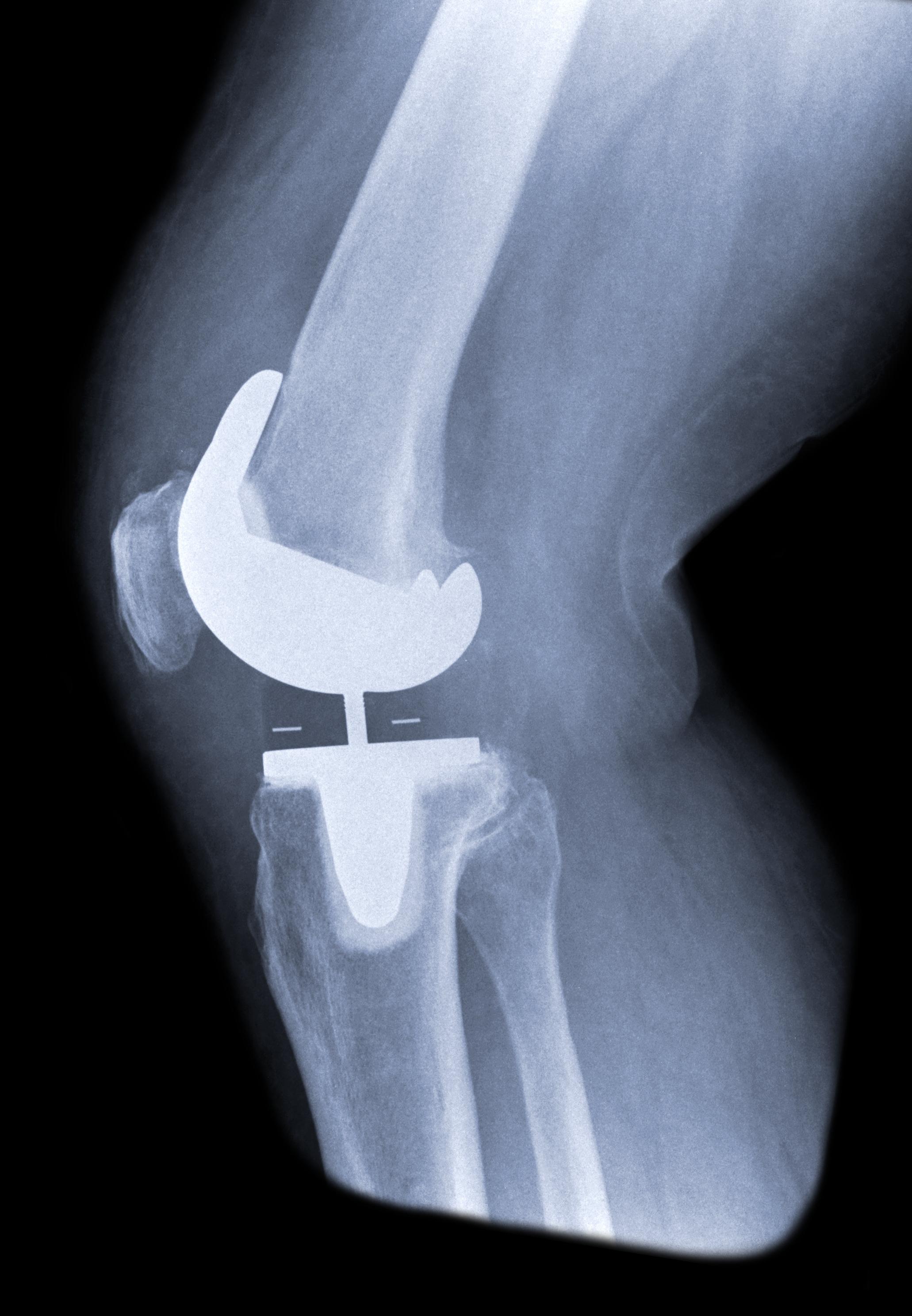 Same-day knee replacement surgery - Mayo Clinic Health System