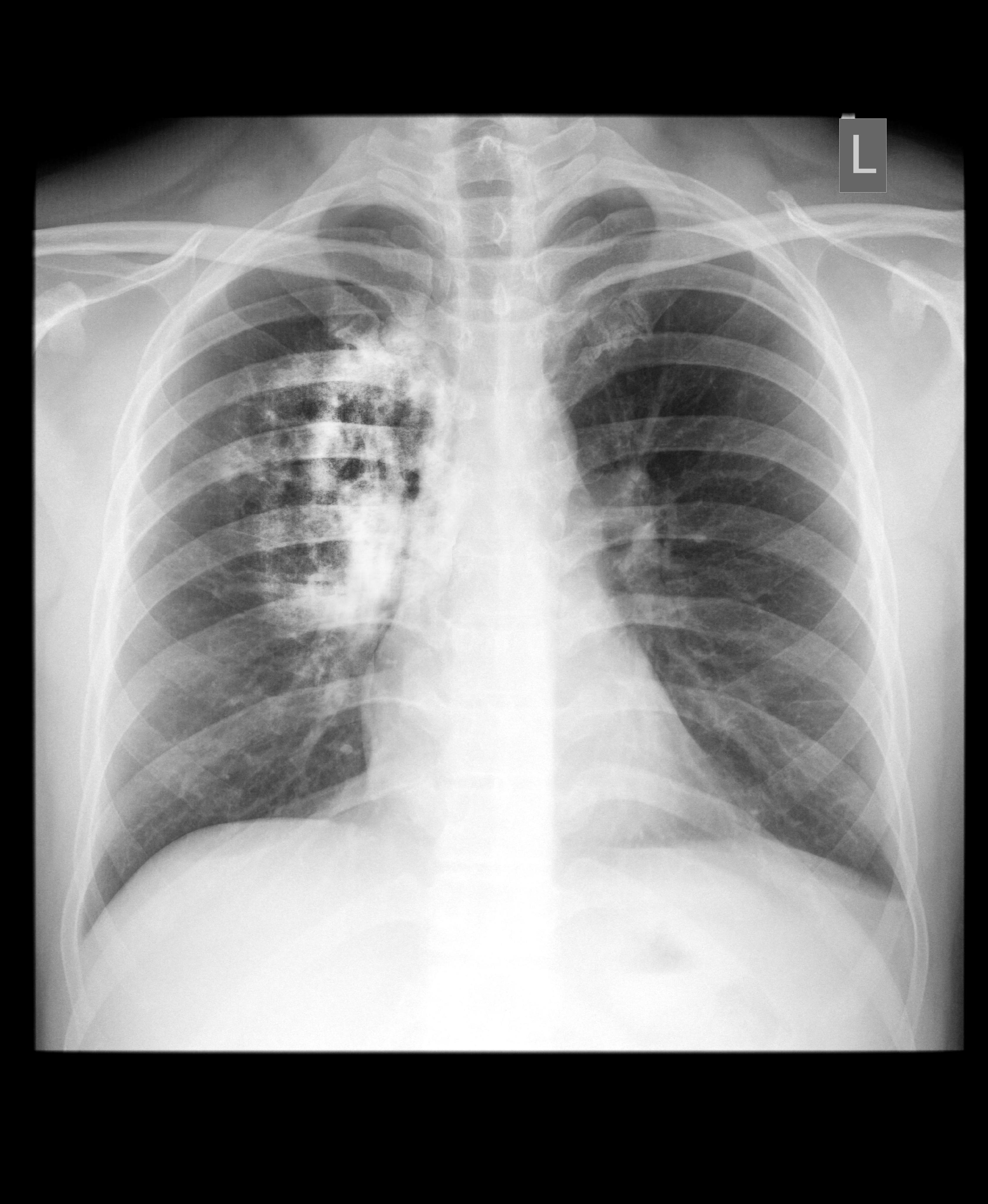 lung cancer pictures images