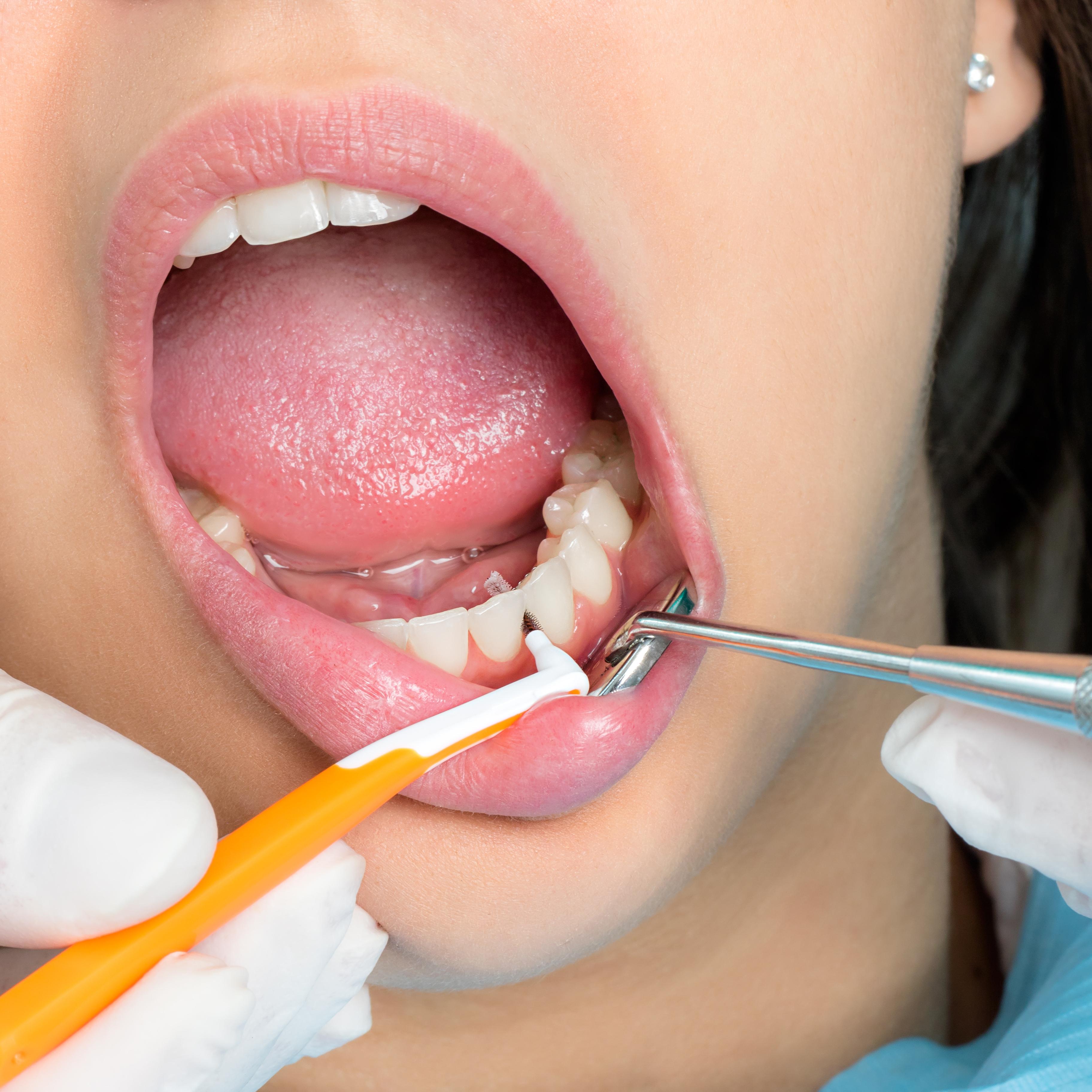 Enfermedades de la boca | Enfermedades bucales | MedlinePlus en español