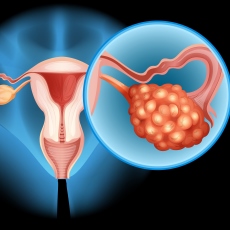 Cáncer de ovario: MedlinePlus en español