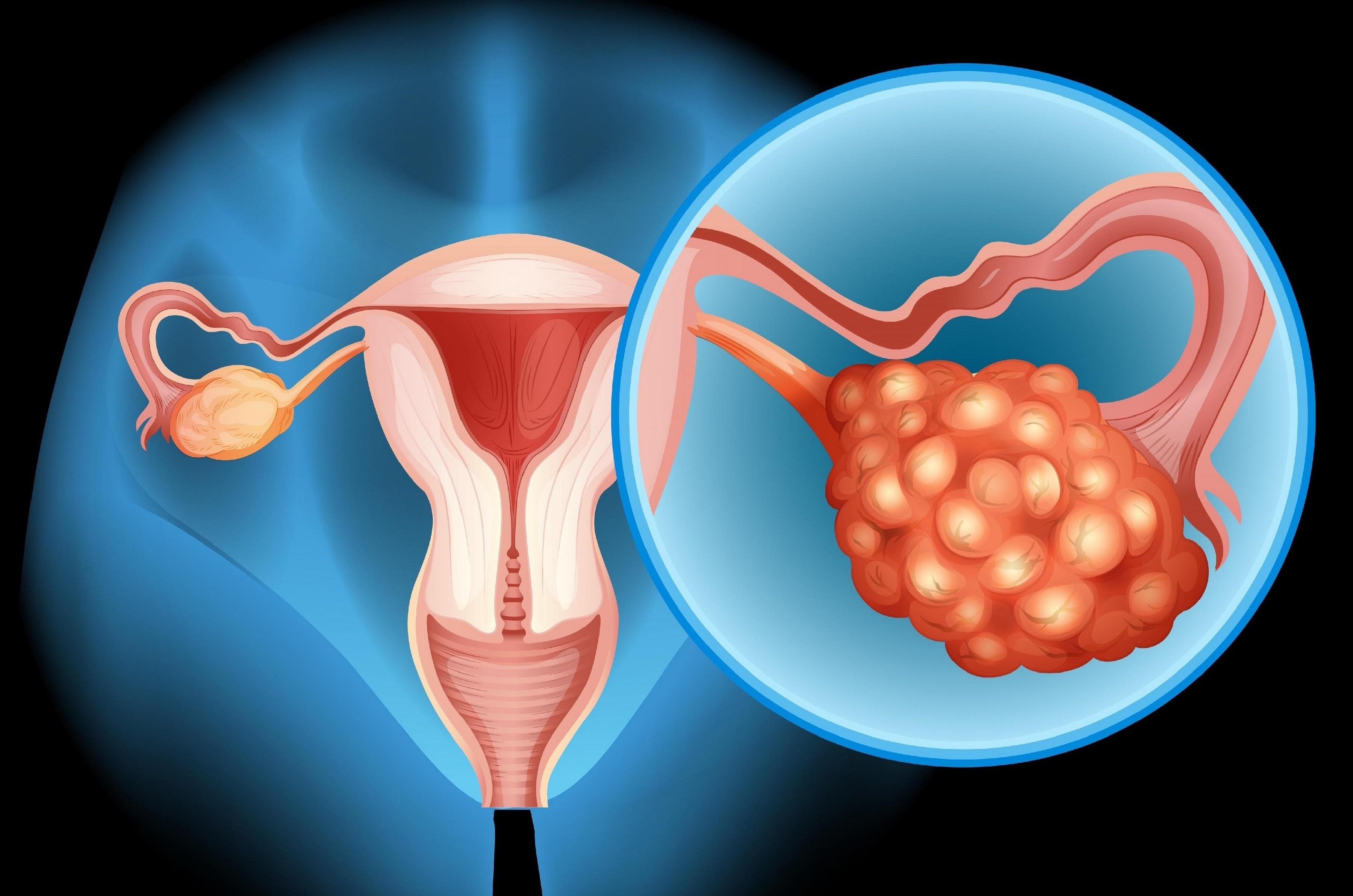 Cáncer de ovario: MedlinePlus en español