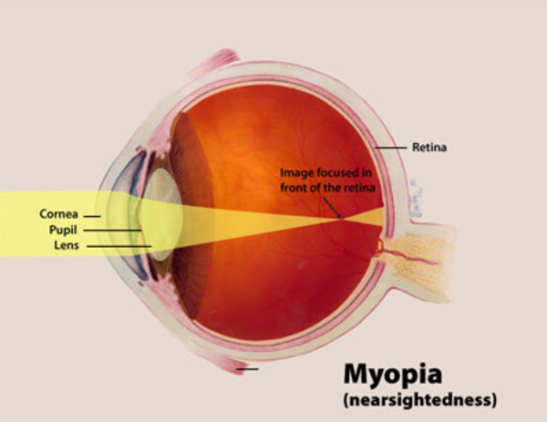 myopia és dysplasia