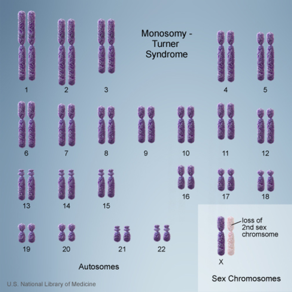 Turner Syndrome Medlineplus Genetics