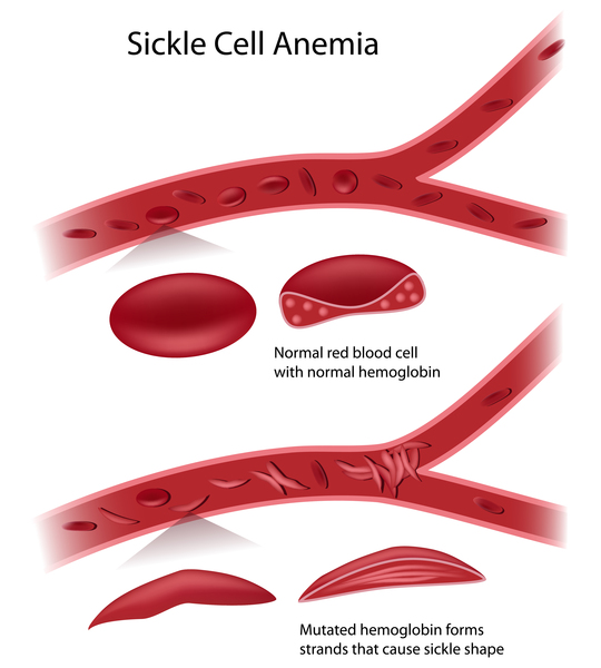 sickle cell anemia karyotype