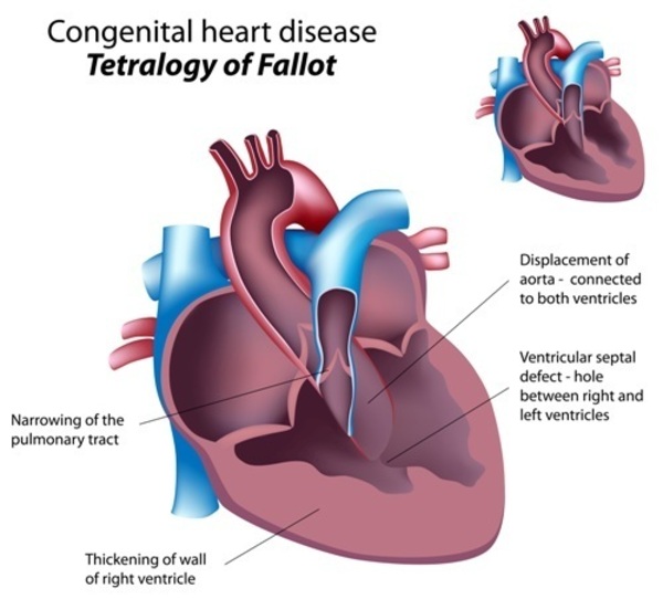 congenital heart defects symptoms