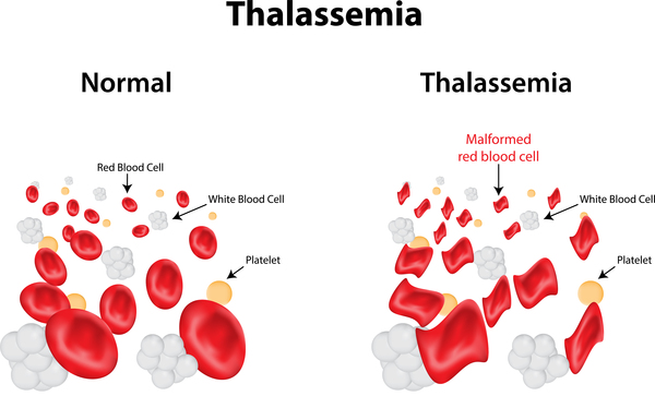 Beta thalassemia: MedlinePlus Genetics