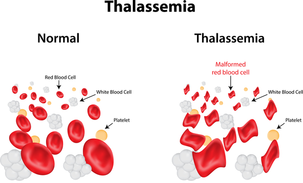 Alpha thalassemia: MedlinePlus Genetics