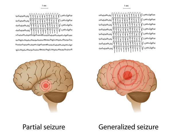 Beta propeller Protein associated Neurodegeneration MedlinePlus Genetics Beta propeller Protein associated Neurodegeneration MedlinePlus Genetics