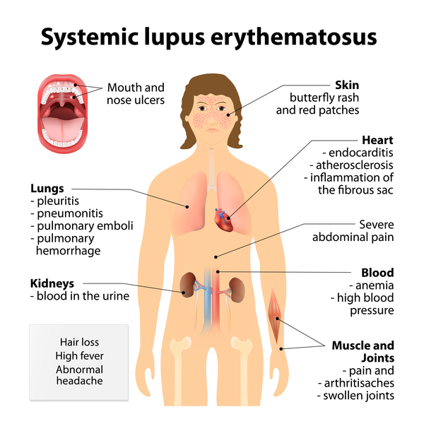 Systemic lupus erythematosus: MedlinePlus Genetics