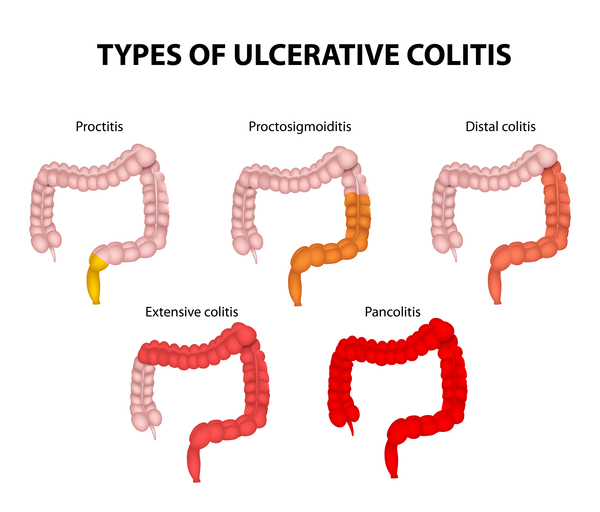 Ulcerative Colitis Stool: Why Your Poop Changes