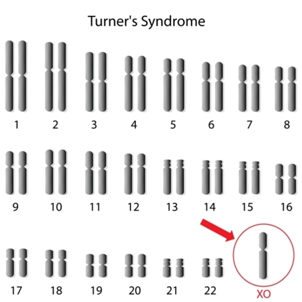 turner syndrome patient