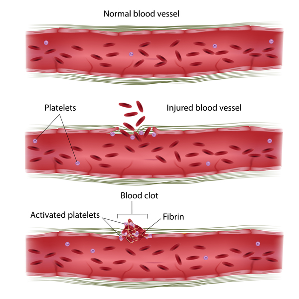 fibrin blood clot