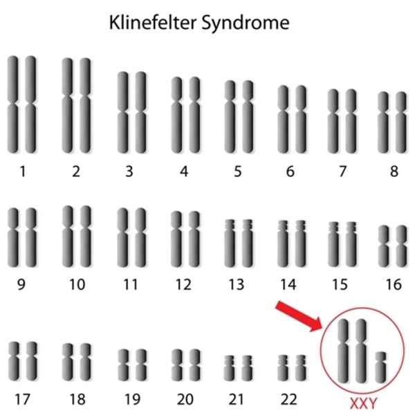 klinefelter syndrome in female