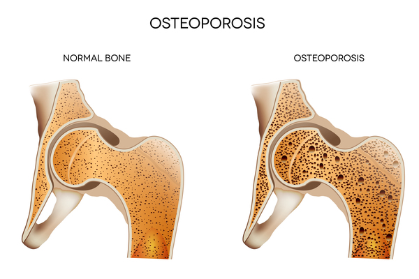Osteoporosis-pseudoglioma syndrome: MedlinePlus Genetics