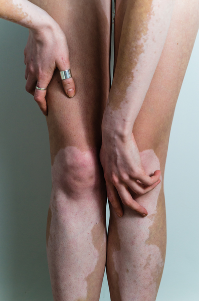 Vitiligo: MedlinePlus Genetics