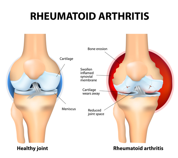 rheumatoid arthritis a kézben izom és ízületi fájdalom és gyengeség