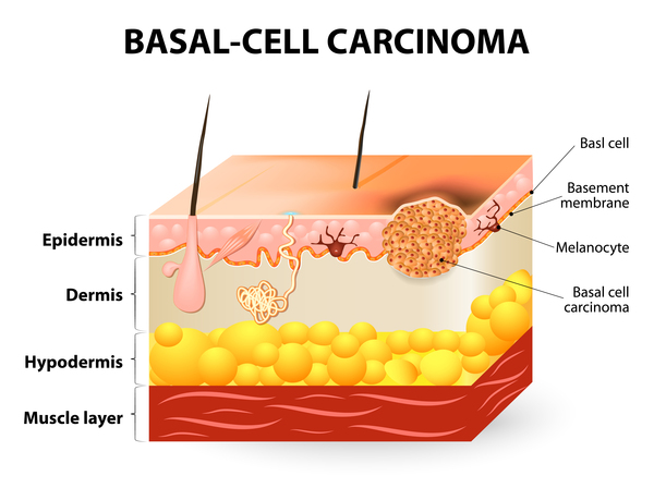Basal Cell Nevus Syndrome