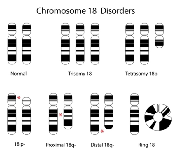 three chromosomes disorder