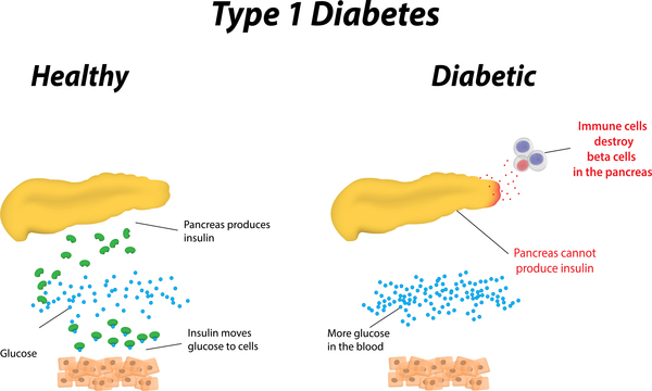 Type 1 Diabetes Medlineplus Genetics 