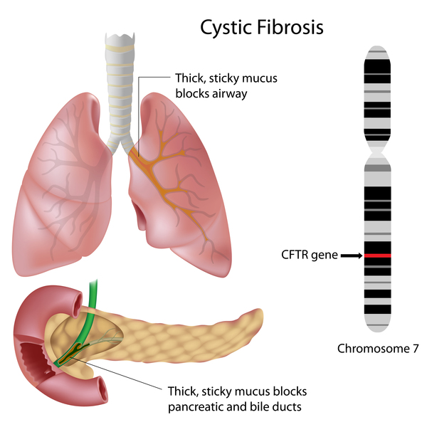 cystic fibrosis research paper outline