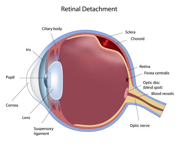 stickler syndrome retina