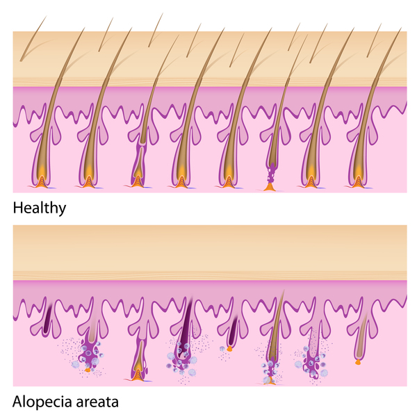 Alopecia areata: MedlinePlus Genetics
