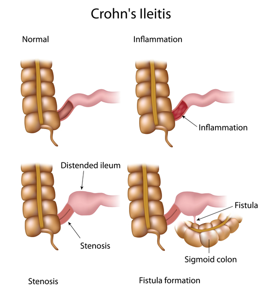 Pathogenesis of Crohn's disease.