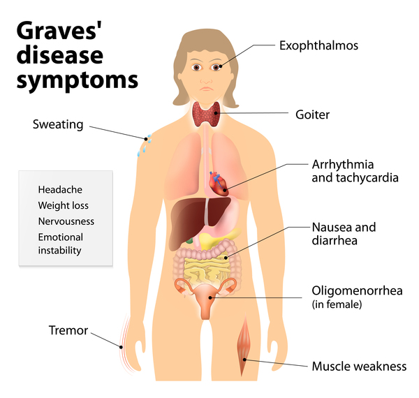 graves disease case study nursing