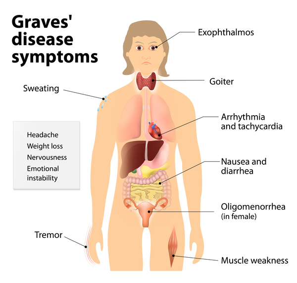 Graves Disease MedlinePlus Genetics