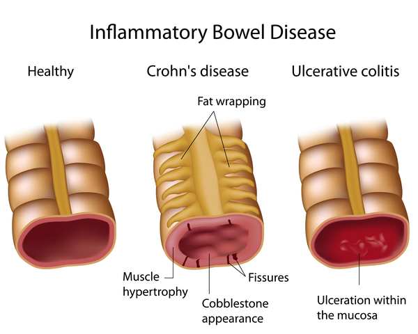 Crohn's disease - The Lancet