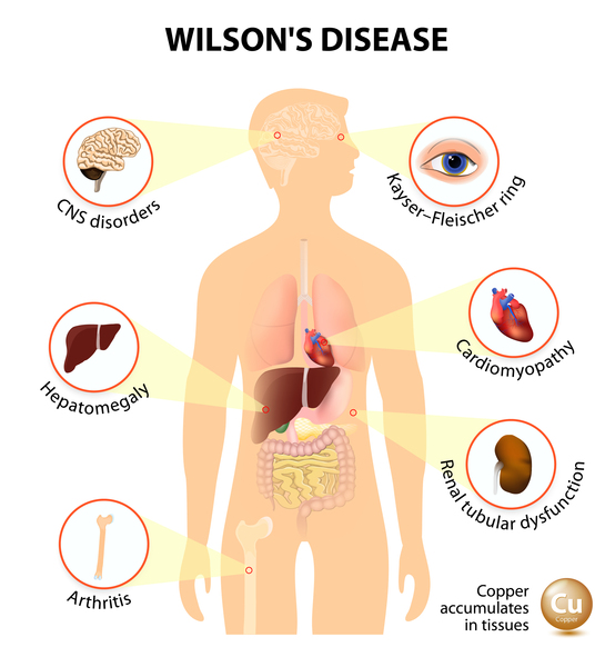 Wilson disease: MedlinePlus Genetics