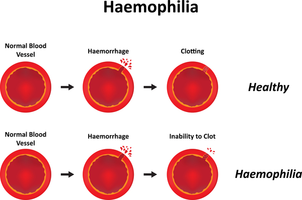 Hemophilia: MedlinePlus Genetics