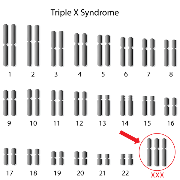 is triple x syndrome recessive or dominant