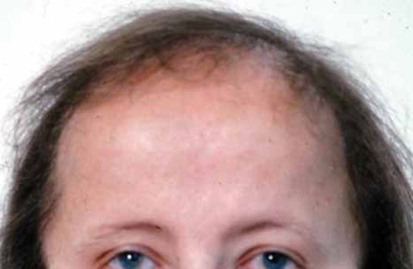 Alopecia adalah
