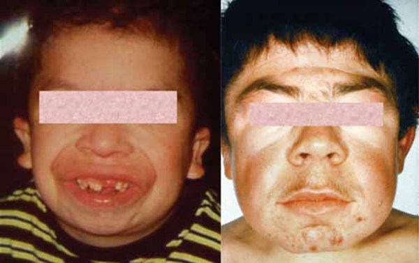 angelman syndrome adults